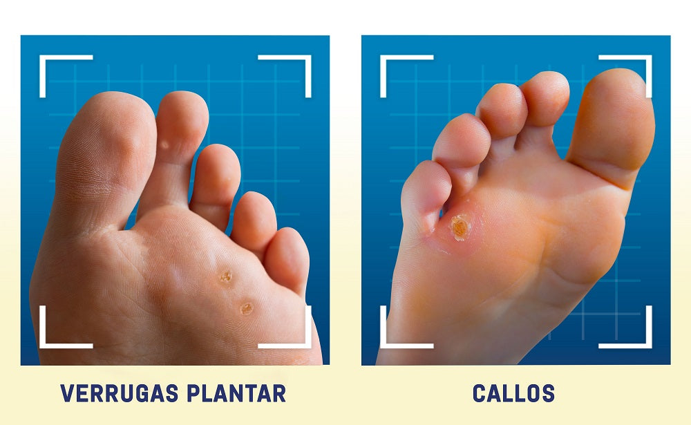 ¿Qué causa las durezas de los pies?
